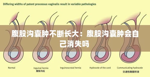腹股沟囊肿不断长大：腹股沟囊肿会自己消失吗 