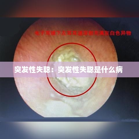 突发性失聪：突发性失聪是什么病 