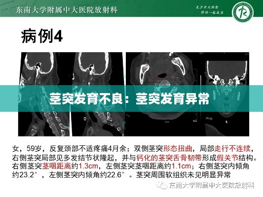 茎突发育不良：茎突发育异常 