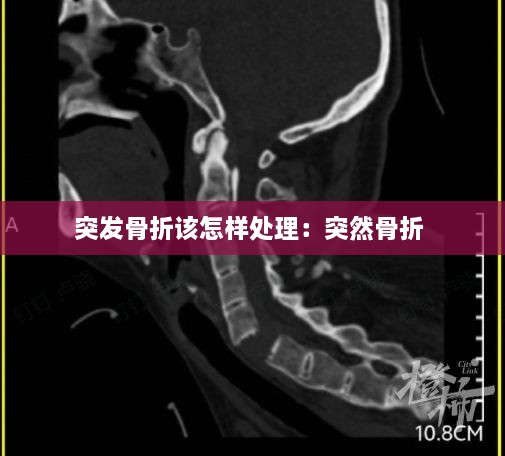 突发骨折该怎样处理：突然骨折 