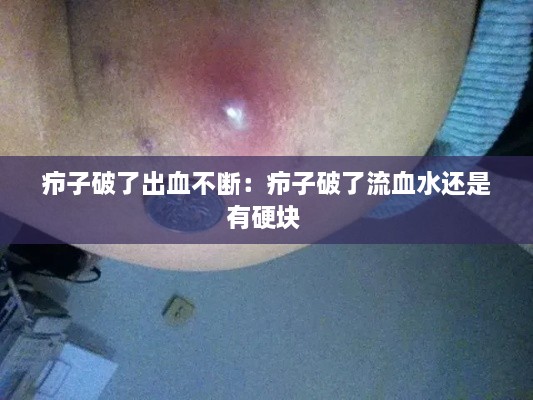 疖子破了出血不断：疖子破了流血水还是有硬块 