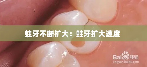 蛀牙不断扩大：蛀牙扩大速度 