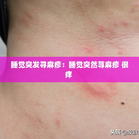 睡觉突发寻麻疹：睡觉突然荨麻疹 很痒 
