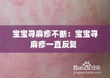 宝宝寻麻疹不断：宝宝寻麻疹一直反复 