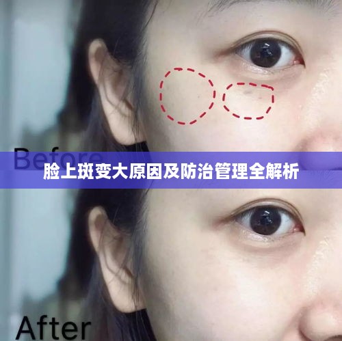 脸上斑变大原因及防治管理全解析