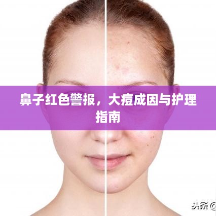 鼻子红色警报，大痘成因与护理指南